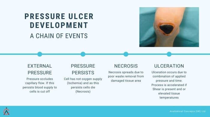 What is a true statement in reporting pressure ulcers