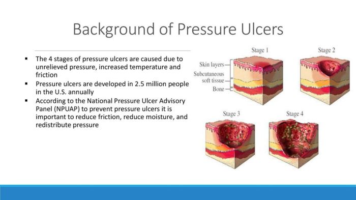 What is a true statement in reporting pressure ulcers